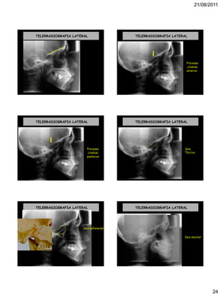 21/08/2011
24
TELERRADIOGRAFIA LATERAL TELERRADIOGRAFIA LATERAL
Processo
clinóide
anterior
TELERRADIOGRAFIA LATERAL
Processo
clinóide
posterior
TELERRADIOGRAFIA LATERAL
Sela
Túrcica
TELERRADIOGRAFIA LATERAL
Seio esfenoidal
TELERRADIOGRAFIA LATERAL
Seio maxilar
 