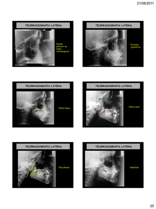 21/08/2011
25
TELERRADIOGRAFIA LATERAL
Parede
anterior da
fossa
infratemporal
TELERRADIOGRAFIA LATERAL
Processo
zigomático
TELERRADIOGRAFIA LATERAL
Palato ósseo
TELERRADIOGRAFIA LATERAL
Palato mole
TELERRADIOGRAFIA LATERAL
Vias aéreas
TELERRADIOGRAFIA LATERAL
Adenóide
 