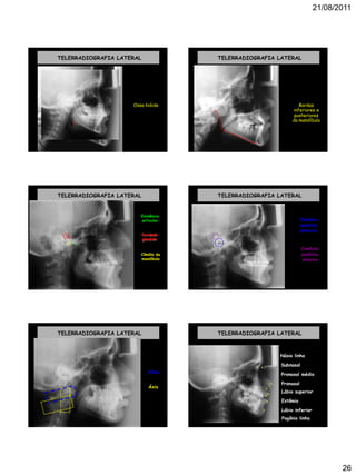21/08/2011
26
TELERRADIOGRAFIA LATERAL
Osso hióide
TELERRADIOGRAFIA LATERAL
Bordas
inferiores e
posteriores
da mandíbula
TELERRADIOGRAFIA LATERAL
Eminência
articular
Cavidade
glenóide
Côndilo da
mandíbula
TELERRADIOGRAFIA LATERAL
Conduto
auditivo
interno
Conduto
auditivo
externo
TELERRADIOGRAFIA LATERAL
Atlas
Áxis
TELERRADIOGRAFIA LATERAL
Násio linha
. Subnasal
.
Pogônio linha
.
Pronasal médio
. Pronasal.
Lábio superior.
Estômio
.
Lábio inferior
.
 