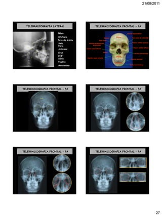 21/08/2011
27
TELERRADIOGRAFIA LATERAL
.
Násio
.
Orbitário
.
Teto da órbita
. Sela
. Pório
. Articular
.
ENA
.
ENP
. Gônio
. Pogônio.
Mentoniano
TELERRADIOGRAFIA FRONTAL - PA
Concha nasal inferior
Frontal
Glabela Asa maior do esfenóide
Fissura orbital superior
Fissura orbital inferior
Lâmina perpendicular
do etmóide
Vômer
Forame supraorbital
Osso nasal
Forame infraorbital
Espinha nasal anterior
Maxila
Mandíbula
Forame mentual
Sínfise mentoniana
TELERRADIOGRAFIA FRONTAL - PA
frontal
TELERRADIOGRAFIA FRONTAL - PA
TELERRADIOGRAFIA FRONTAL - PA TELERRADIOGRAFIA FRONTAL - PA
 
