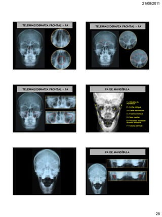 21/08/2011
28
TELERRADIOGRAFIA FRONTAL - PA TELERRADIOGRAFIA FRONTAL - PA
TELERRADIOGRAFIA FRONTAL - PA PA DE MANDÍBULA
1 1
2 2
3
4
5 5
6 6
7
1 – Côndilo da
mandíbula
2 – Linha oblíqua
3 – Canal mandibular
4 – Forame mentual
5 – Seio maxilar
6 – Processo mastóide
do osso temporal
7 – Coluna cervical
PA DE MANDÍBULA
 