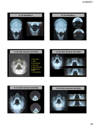 21/08/2011
29
PA DE MANDÍBULA PA DE MANDÍBULA
PA DE SEIO MAXILAR (WATERS)
1 – Seio maxilar
2 – Órbita
3 – Seio esfenoidal
4 – Osso nasal
5 – Septo nasal ósseo
6 – Espinha nasal
posterior
7 – Arco zigomático
1 1
2 2
33
4 4
5
6
7
7
PA DE SEIO MAXILAR (WATERS)
PA DE SEIO MAXILAR (WATERS) PA DE SEIO MAXILAR (WATERS)
 
