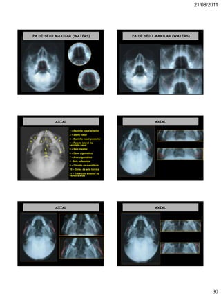 21/08/2011
30
PA DE SEIO MAXILAR (WATERS) PA DE SEIO MAXILAR (WATERS)
AXIAL
1 – Espinha nasal anterior
2 – Septo nasal
3 – Espinha nasal posterior
4 – Parede lateral da
cavidade nasal
5 – Seio maxilar
6 – Osso zigomático
7 – Arco zigomático
8 - Seio esfenoidal
9 – Côndilo da mandíbula
10 – Dorso da sela túrcica
11 – Tubérculo anterior da
vértebra atlas
1
2
3
4 4
5 5
6 6
7
78
910
11
AXIAL
AXIAL AXIAL
 