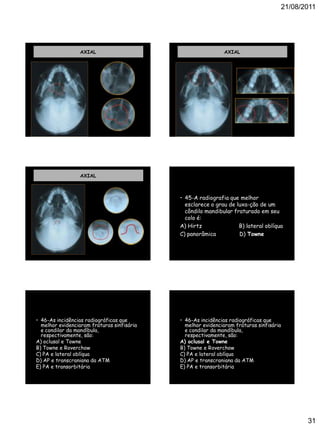 21/08/2011
31
AXIAL AXIAL
AXIAL
• 45-A radiografia que melhor
esclarece o grau de luxa-ção de um
côndilo mandibular fraturado em seu
colo é:
A) Hirtz B) lateral oblíqua
C) panorâmica D) Towne
• 46-As incidências radiográficas que
melhor evidenciaram fraturas sinfisária
e condilar da mandíbula,
respectivamente, são:
A) oclusal e Towne
B) Towne e Roverchow
C) PA e lateral oblíqua
D) AP e transcraniana da ATM
E) PA e transorbitária
• 46-As incidências radiográficas que
melhor evidenciaram fraturas sinfisária
e condilar da mandíbula,
respectivamente, são:
A) oclusal e Towne
B) Towne e Roverchow
C) PA e lateral oblíqua
D) AP e transcraniana da ATM
E) PA e transorbitária
 