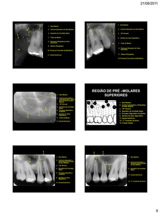 21/08/2011
9
1
7
1. Seio Maxilar
7. Túber da Maxila
10. Processo Coronóide da Mandíbula
11. Canais Nutritivos
2. Cortical (Assoalho) do Seio Maxilar
2
10
11
9
9. Hâmulo Pterigóideo
4. Assoalho da Cavidade Nasal
4
8
8. Processo Pterigóide do Osso
Esfenóide
1
7
1. Seio Maxilar
7. Túber da Maxila
3 3. “W” Sinusal
10. Processo Coronóide da Mandíbula
6
2. Cortical (Assoalho) do Seio Maxilar
6. Sombra do Osso Zigomático
2
10
9
9. Hâmulo Pterigóideo
8
8. Processo Pterigóide do Osso
Esfenóide
1
7
5
2
1. Seio Maxilar
5. Processo Zigomático
da Maxila
7. Túber da Maxila
3
3. “W” Sinusal
11. Canais Nutritivos
6
2. Cortical (Assoalho) e
Extensões para Túber e
para Alveolar do Seio
Maxilar
6. Sombra do Osso
Zigomático
11
4. Assoalho da Cavidade
Nasal
4
2
REGIÃO DE PRÉ –MOLARES
SUPERIORES
1. Seio Maxilar
2. Cortical (Assoalho) e Extensões
do Seio Maxilar
3. “W” Sinusal
4. Assoalho da Cavidade Nasal
5. Processo Zigomático da Maxila
6. Sombra do Osso Zigomático
11. Canais Nutritivos
12. “Y” Invertido de Ennis
13. Fossas Nasais
4
2
5
1
6
3 12
1
5
2
1. Seio Maxilar
5. Processo Zigomático
da Maxila
3
3. “W” Sinusal
6
2. Cortical (Assoalho) e
Extensão para Alveolar
do Seio Maxilar
6. Sombra do Osso
Zigomático
4. Assoalho da Cavidade
Nasal
4
11. Canais Nutritivos
11
1
2
1. Seio Maxilar
2. Cortical (Assoalho) e
Extensão para Alveolar
do Seio Maxilar
11. Canais Nutritivos
11
4. Assoalho da Cavidade
Nasal
4
12
12. “Y” Invertido de Ennis
4
 