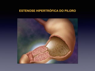 Aula abdome lactente - cirurgia iii | PPTX