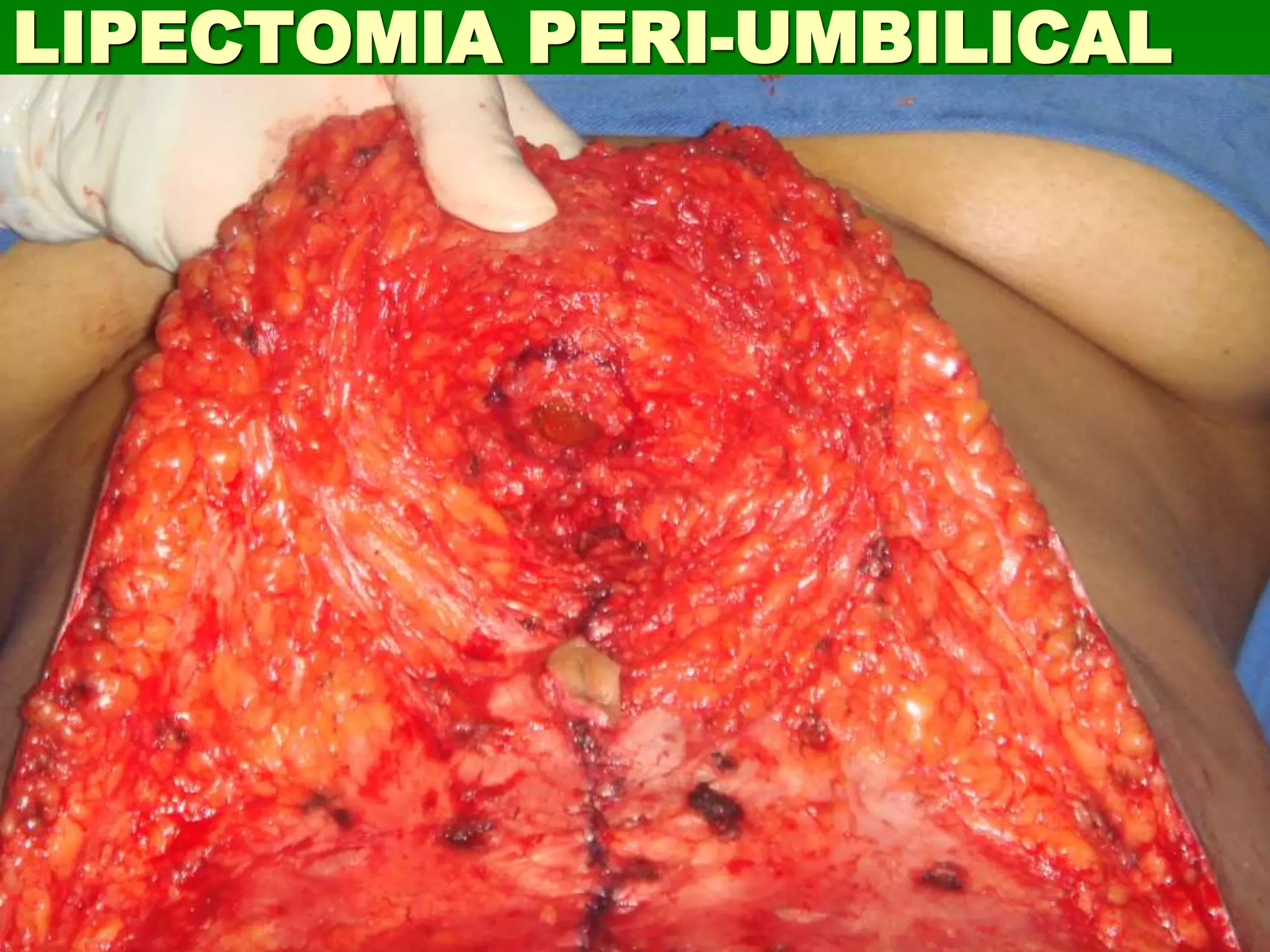 LIPECTOMIA PERI-UMBILICAL
 
