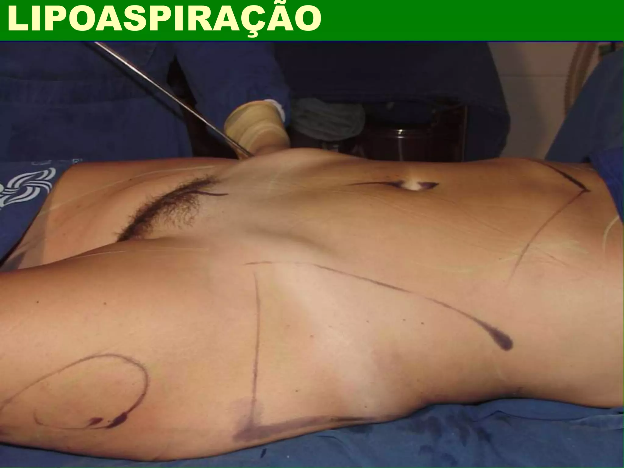 LIPOASPIRAÇÃO
 