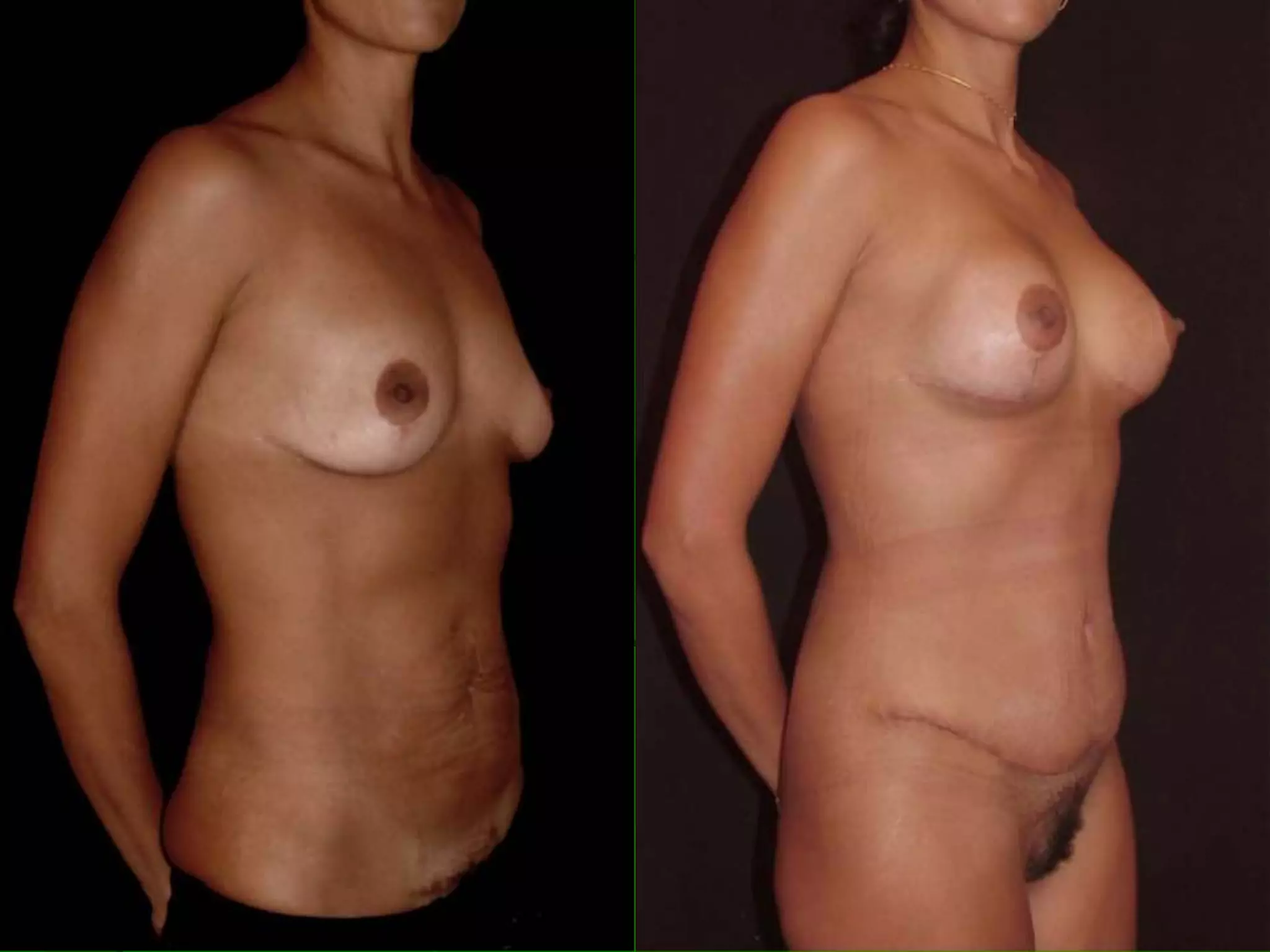  Abdominoplastia 