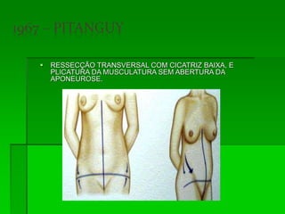  RESSECÇÃO TRANSVERSAL COM CICATRIZ BAIXA, E
PLICATURA DA MUSCULATURA SEM ABERTURA DA
APONEUROSE.
 