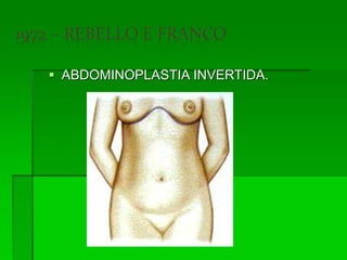  ABDOMINOPLASTIA INVERTIDA.
 