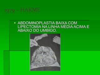  ABDOMINOPLASTIA BAIXA COM
LIPECTOMIA NA LINHA MÉDIA ACIMA E
ABAIXO DO UMBIGO.
 