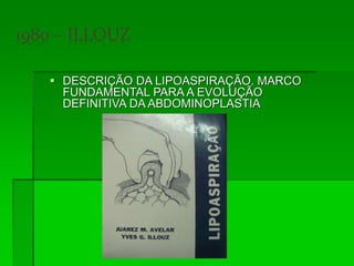  DESCRIÇÃO DA LIPOASPIRAÇÃO. MARCO
FUNDAMENTAL PARA A EVOLUÇÃO
DEFINITIVA DA ABDOMINOPLASTIA
 