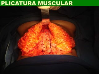 PLICATURA MUSCULAR
 