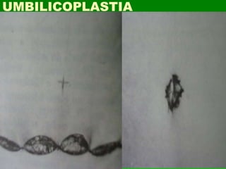 UMBILICOPLASTIA
 