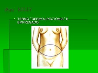  TERMO “DERMOLIPECTOMIA” É
EMPREGADO.
 