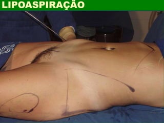LIPOASPIRAÇÃO
 