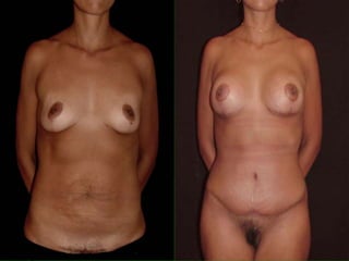  Abdominoplastia 