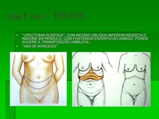  “LIPECTOMIA PLÁSTICA”, COM INCISÃO OBLÍQUA INFERIOR RESSECA O
ABDOME EM PÊNDULO, COM POSTERIOR ENXERTO DO UMBIGO. PORÉM
SUGERE A TRANSPOSIÇÃO UMBILICAL.
 “ASA DE MORCEGO”.
 