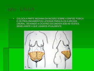  COLOCA A PARTE MEDIANA DA INCISÃO SOBRE A SÍNFISE PÚBICA
E OS PROLONGAMENTOS LATERAIS PARALELOS A ARCADA
CRURAL, DEIXANDO A CICATRIZ ESCONDIDA SOB AS VESTES,
SEMELHANTE A QUE USAMOS ATUALMENTE.
 