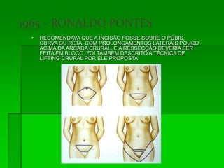  RECOMENDAVA QUE A INCISÃO FOSSE SOBRE O PÚBIS,
CURVA OU RETA, COM PROLONGAMENTOS LATERAIS POUCO
ACIMA DA ARCADA CRURAL, E A RESSECÇÃO DEVERIA SER
FEITA EM BLOCO. FOI TAMBÉM DESCRITO A TÉCNICA DE
LIFTING CRURAL POR ELE PROPOSTA.
 