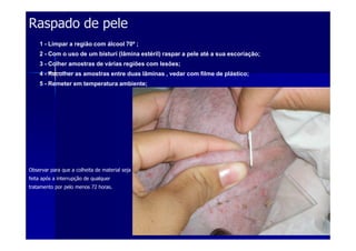 Raspado de peleRaspado de pele
1 - Limpar a região com álcool 70º ;
2 - Com o uso de um bisturi (lâmina estéril) raspar a pele até a sua escoriação;
3 - Colher amostras de várias regiões com lesões;
4 - Recolher as amostras entre duas lâminas , vedar com filme de plástico;
5 - Remeter em temperatura ambiente;
Observar para que a colheita de material seja
feita após a interrupção de qualquer
tratamento por pelo menos 72 horas.
 