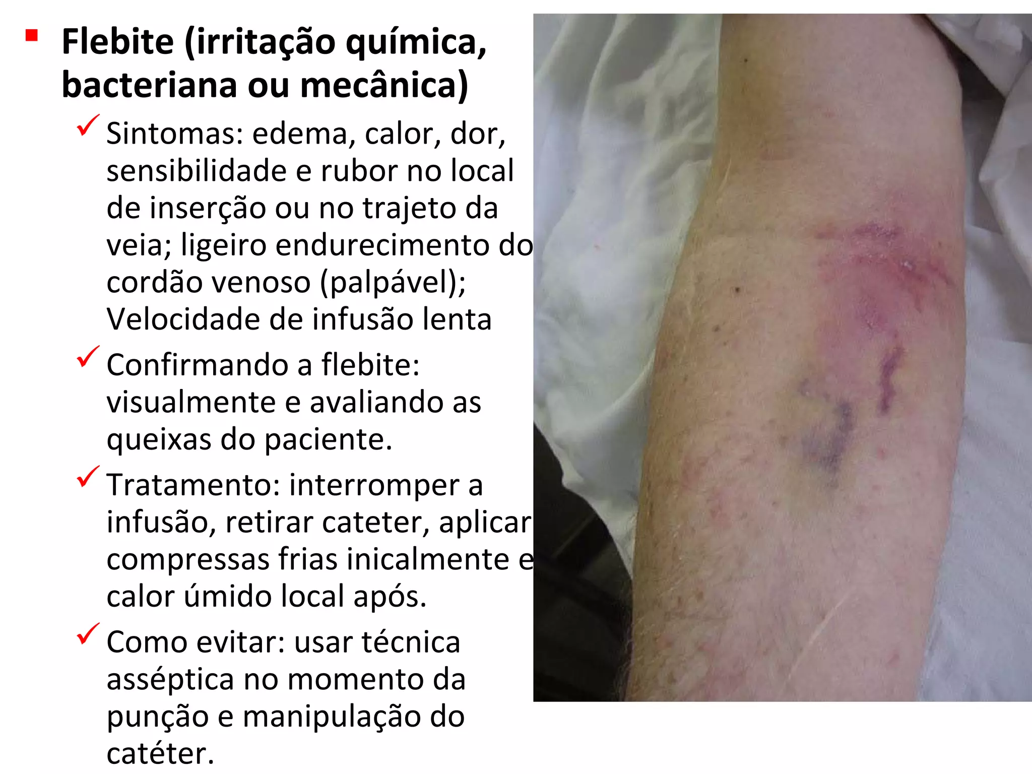  Flebite (irritação química,
bacteriana ou mecânica)
Sintomas: edema, calor, dor,
sensibilidade e rubor no local
de inserção ou no trajeto da
veia; ligeiro endurecimento do
cordão venoso (palpável);
Velocidade de infusão lenta
Confirmando a flebite:
visualmente e avaliando as
queixas do paciente.
Tratamento: interromper a
infusão, retirar cateter, aplicar
compressas frias inicalmente e
calor úmido local após.
Como evitar: usar técnica
asséptica no momento da
punção e manipulação do
catéter.
 