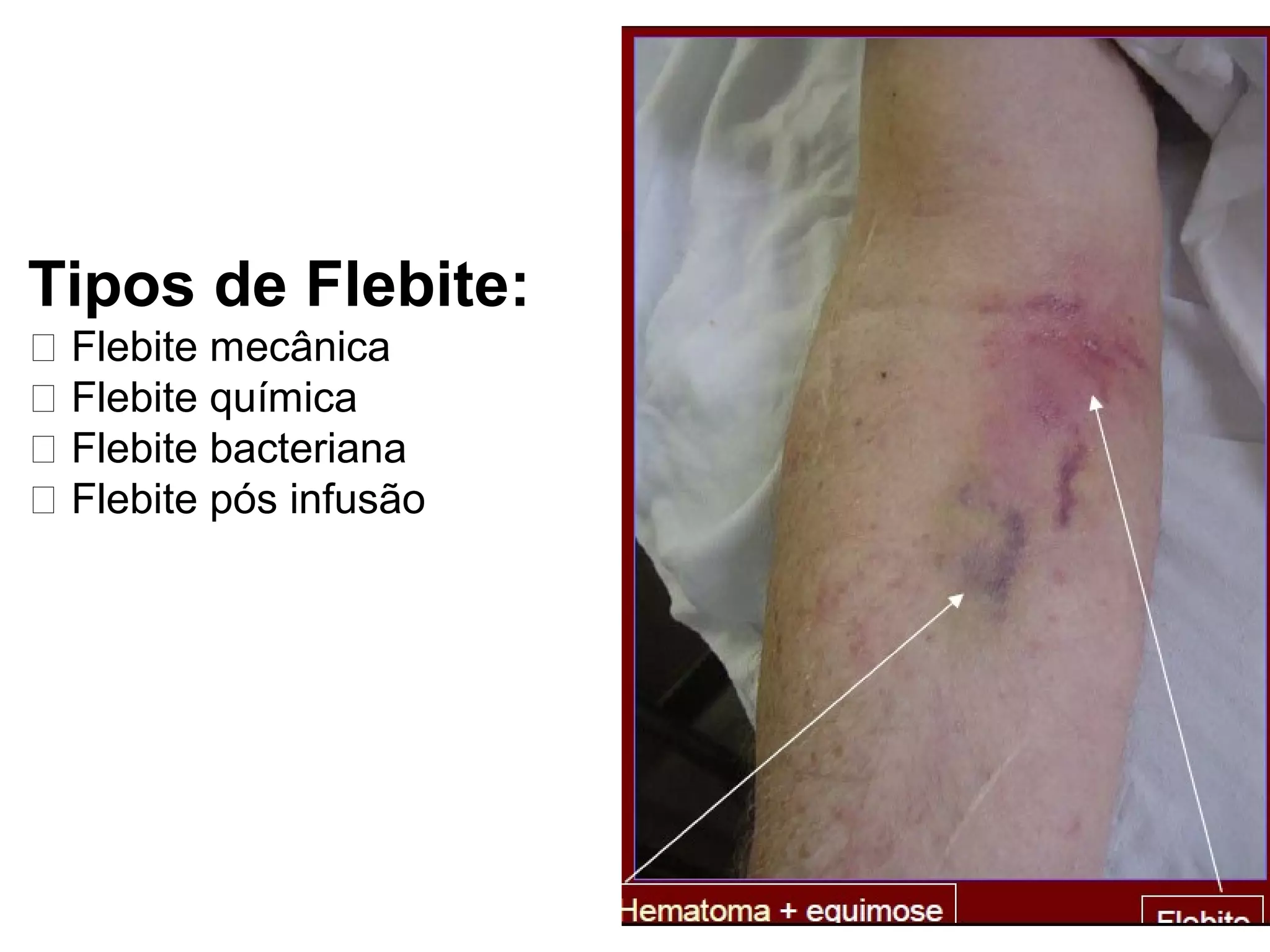 Tipos de Flebite:
􀂄 Flebite mecânica
􀂄 Flebite química
􀂄 Flebite bacteriana
􀂄 Flebite pós infusão
 
