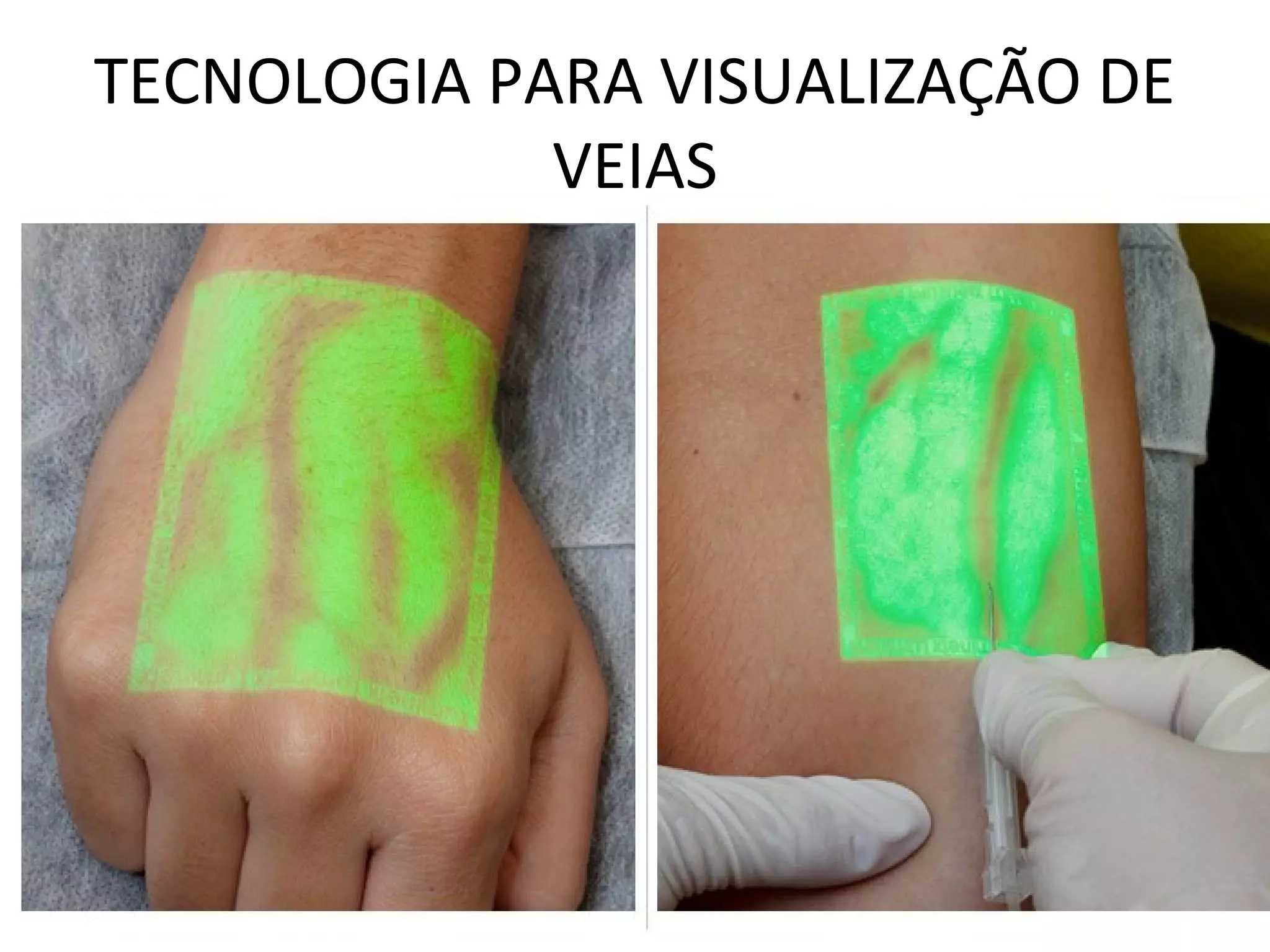 TECNOLOGIA PARA VISUALIZAÇÃO DE
VEIAS
 