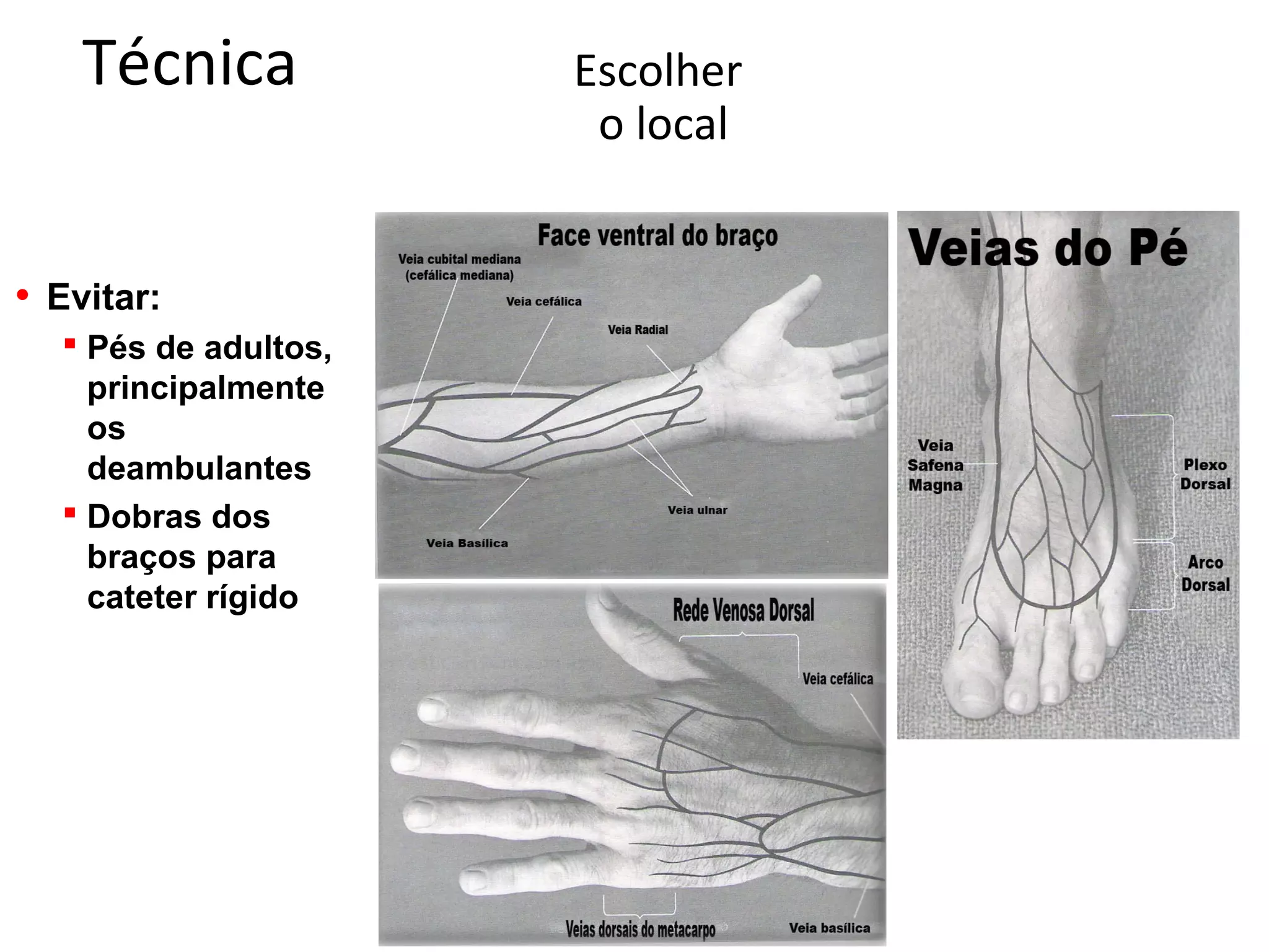 Técnica Escolher
o local
• Evitar:
 Pés de adultos,
principalmente
os
deambulantes
 Dobras dos
braços para
cateter rígido
 
