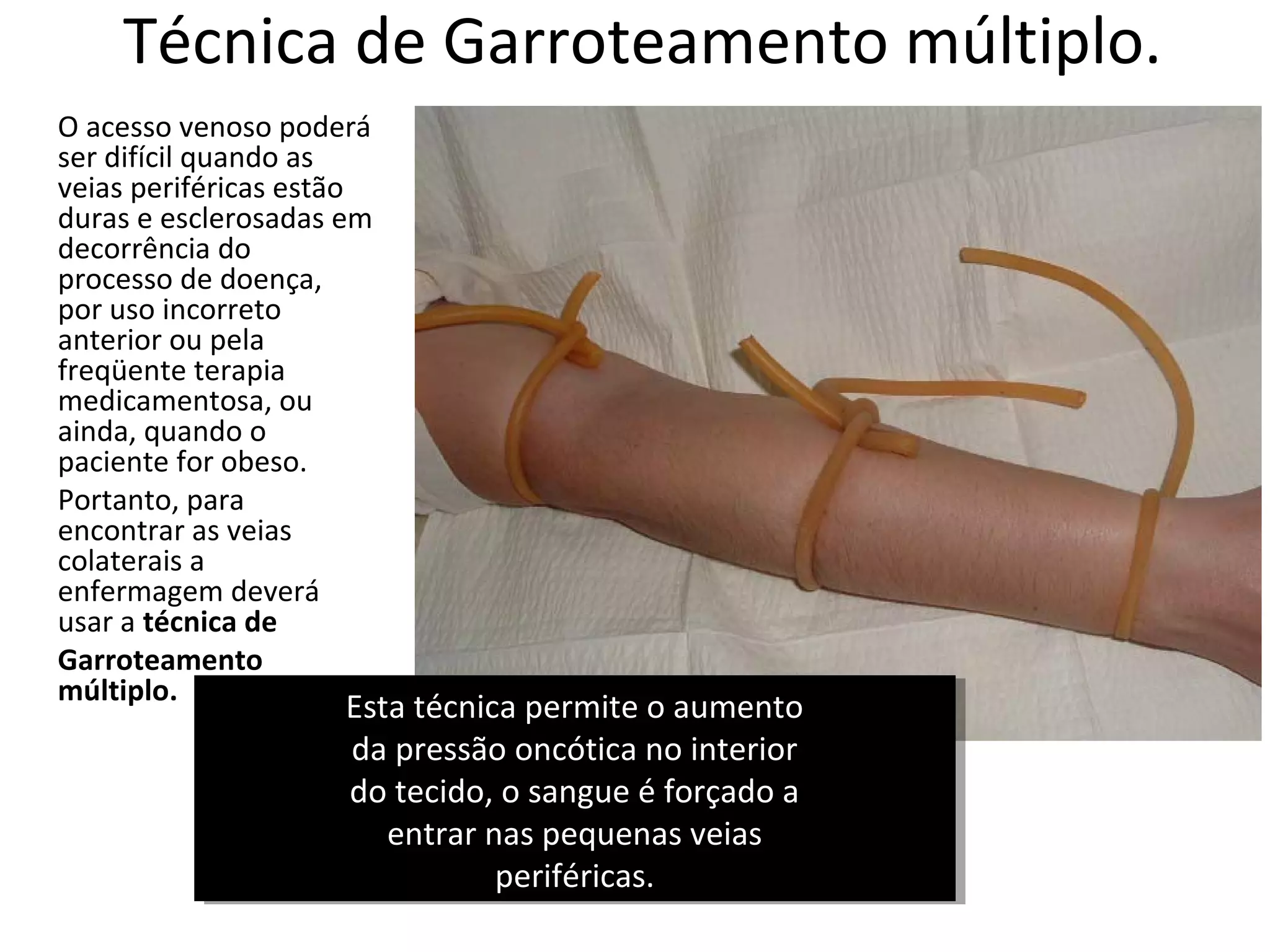 Técnica de Garroteamento múltiplo.
O acesso venoso poderá
ser difícil quando as
veias periféricas estão
duras e esclerosadas em
decorrência do
processo de doença,
por uso incorreto
anterior ou pela
freqüente terapia
medicamentosa, ou
ainda, quando o
paciente for obeso.
Portanto, para
encontrar as veias
colaterais a
enfermagem deverá
usar a técnica de
Garroteamento
múltiplo.
Esta técnica permite o aumento
da pressão oncótica no interior
do tecido, o sangue é forçado a
entrar nas pequenas veias
periféricas.
Esta técnica permite o aumento
da pressão oncótica no interior
do tecido, o sangue é forçado a
entrar nas pequenas veias
periféricas.
 