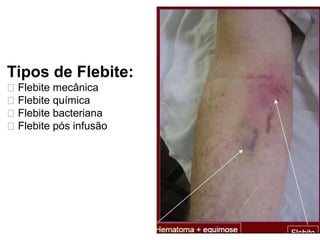 Tipos de Flebite:
􀂄 Flebite mecânica
􀂄 Flebite química
􀂄 Flebite bacteriana
􀂄 Flebite pós infusão
 