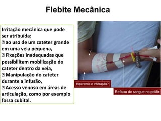 Irritação mecânica que pode
ser atribuída:
􀂄 ao uso de um cateter grande
em uma veia pequena,
􀂄 Fixações inadequadas que
possibilitem mobilização do
cateter dentro da veia,
􀂄 Manipulação do cateter
durante a infusão,
􀂄 Acesso venoso em áreas de
articulação, como por exemplo
fossa cubital.
Flebite Mecânica
 