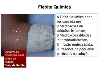 Flebite Química
A Flebite química pode
ser causada por:
􀂄 Medicações ou
soluções irritantes,
􀂄 Medicações diluídas
inapropriadamente,
􀂄 Infusão muito rápida,
􀂄 Presença de pequenas
partículas na solução.
 