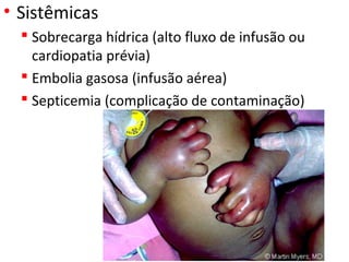 • Sistêmicas
 Sobrecarga hídrica (alto fluxo de infusão ou
cardiopatia prévia)
 Embolia gasosa (infusão aérea)
 Septicemia (complicação de contaminação)
 