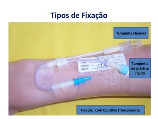 Tipos de Fixação
Fixação com Curativo Transparente
Tampinha Flexível
Tampinha
de plástico
rígido
 