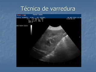 Técnica de varredura
 