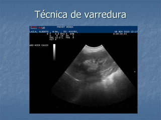 Técnica de varredura
 