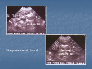 Hiperplasia adrenal bilateral
 