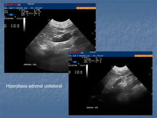 Hiperplasia adrenal unilateral
 