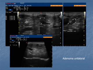 Adenoma unilateral
 