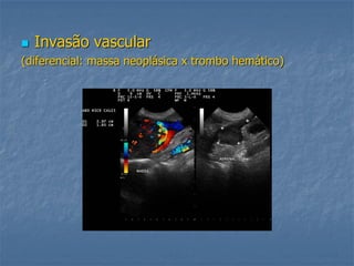  Invasão vascular
(diferencial: massa neoplásica x trombo hemático)
 