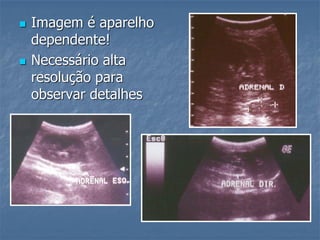  Imagem é aparelho
dependente!
 Necessário alta
resolução para
observar detalhes
 