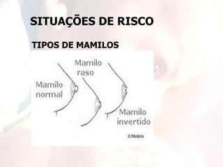 SITUAÇÕES DE RISCO

TIPOS DE MAMILOS
 