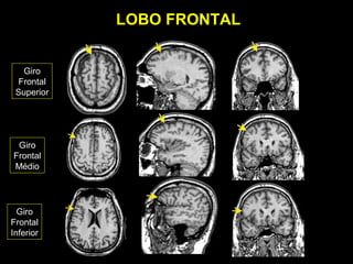 LOBO FRONTAL


  Giro
 Frontal
 Superior




 Giro
Frontal
Médio




  Giro
Frontal
Inferior
 