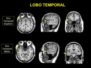 LOBO TEMPORAL


   Giro
 Temporal
 Superior




  Giro
Temporal
 Médio
 