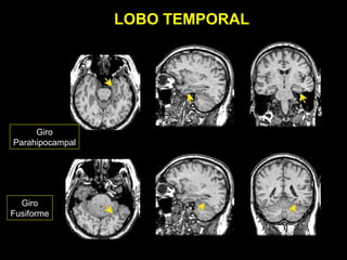 LOBO TEMPORAL




     Giro
Parahipocampal




  Giro
Fusiforme
 