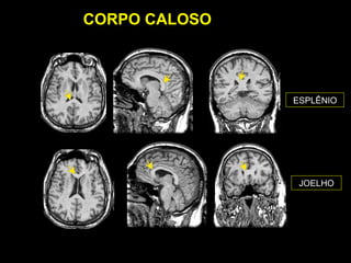 CORPO CALOSO




               ESPLÊNIO




                JOELHO
 