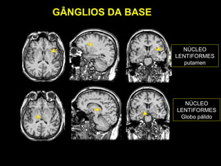 GÂNGLIOS DA BASE


                     NÚCLEO
                   LENTIFORMES
                      putamen




                     NÚCLEO
                   LENTIFORMES
                    Globo pálido
 