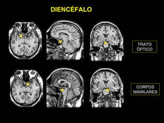 DIENCÉFALO




              TRATO
              ÓPTICO




              CORPOS
             MAMILARES
 